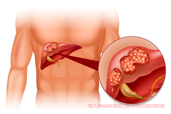 肝癌症状