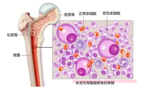 多发性骨髓瘤骨髓