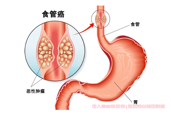 食道癌能治愈吗