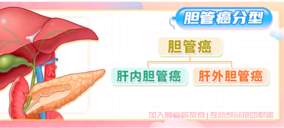 胆管癌分类