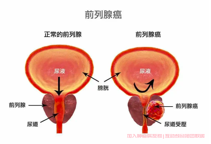 前列腺癌预防