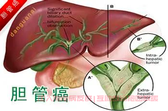 胆管癌转移