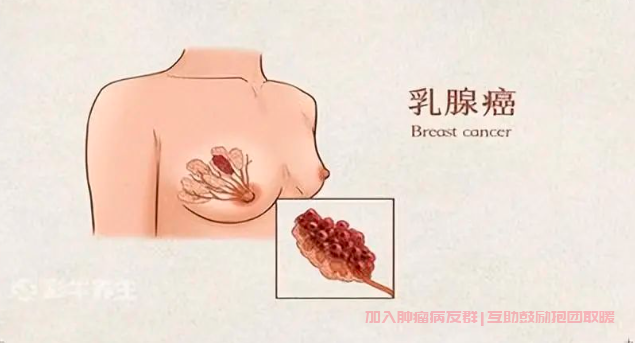 乳腺癌交流群