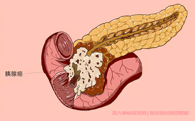 胰腺癌交流群