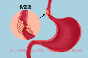 食管癌