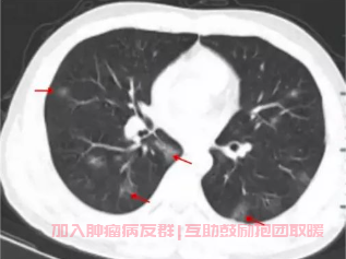 肺结节