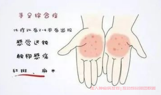 化疗后手足综合征