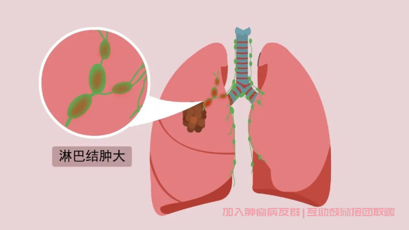 肺癌淋巴结增大