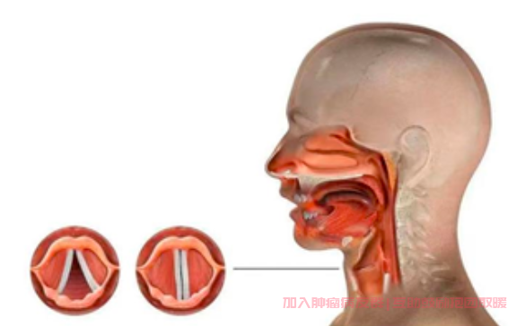 喉癌的早期症状及表现
