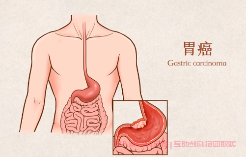 胃恶性肿瘤