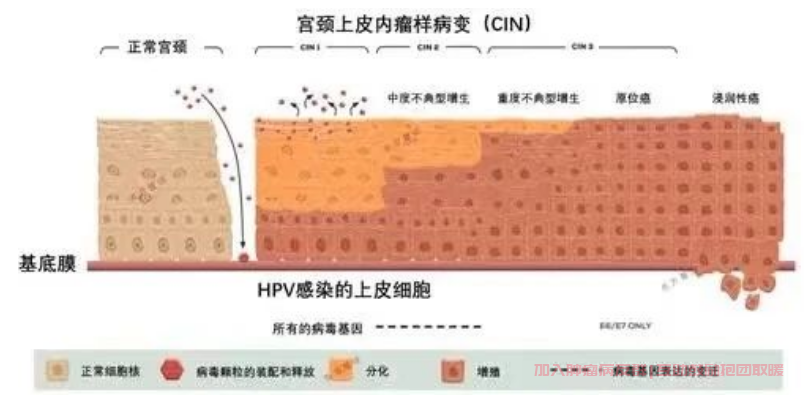 宫颈上皮内瘤样病变(CIN)
