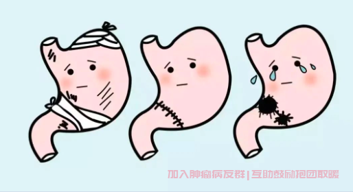 胃癌术后疼痛