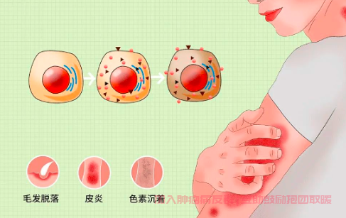 放疗皮肤问题脱发皮炎色素沉着