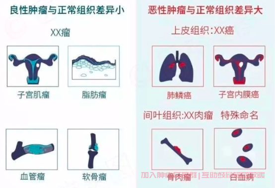 良性肿瘤与恶性肿瘤区别