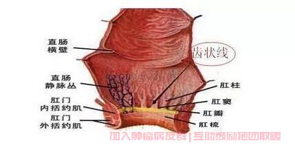 直肠癌保留肛门