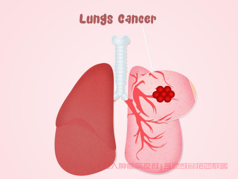 肺癌