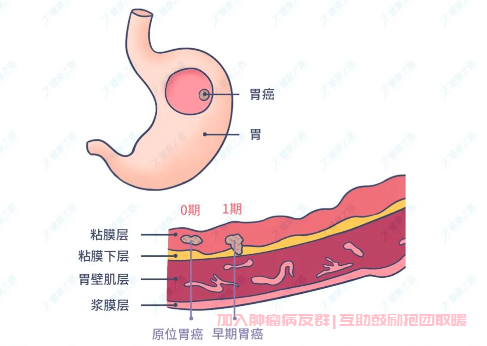 早期胃癌如何治疗