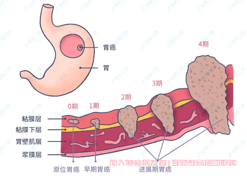 进展期胃癌如何治疗