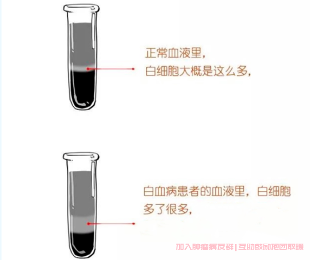 白血病血液的区别