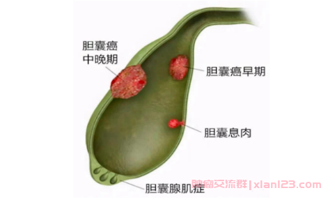 胆囊癌术后