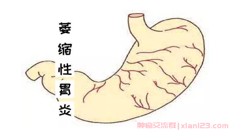 萎缩性胃炎会得胃癌吗