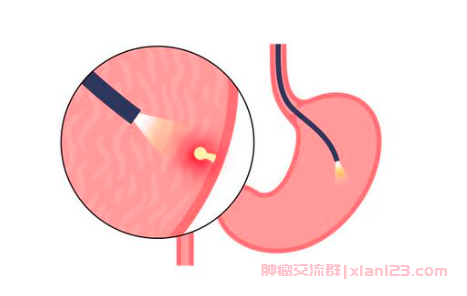 胃镜显示上皮内瘤变是胃癌吗