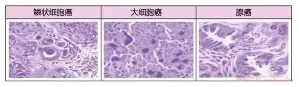 肺癌中的腺癌、鳞癌