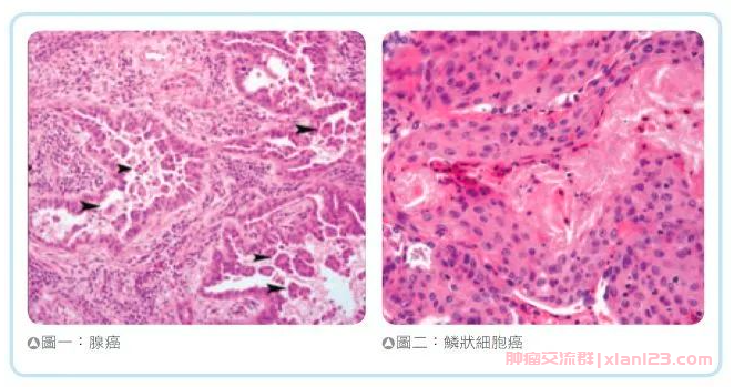 肺腺癌与肺鳞癌病理特征区别