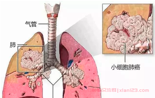 小细胞肺癌