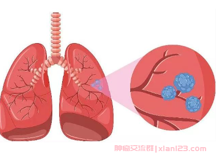 肺部实性结节