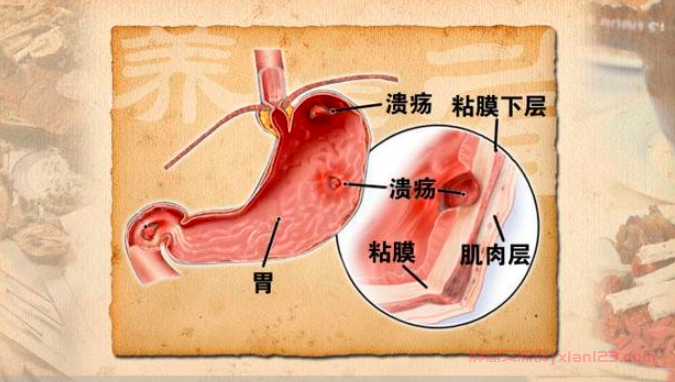 胃溃疡就是胃癌吗？胃溃疡与胃癌重要的关联揭秘