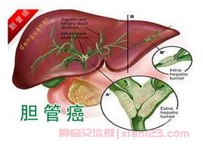 肝门胆管癌病友群