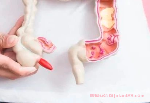 结肠癌晚期患者群加入，了解晚期结肠癌的预后与治疗