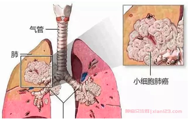 小细胞肺癌