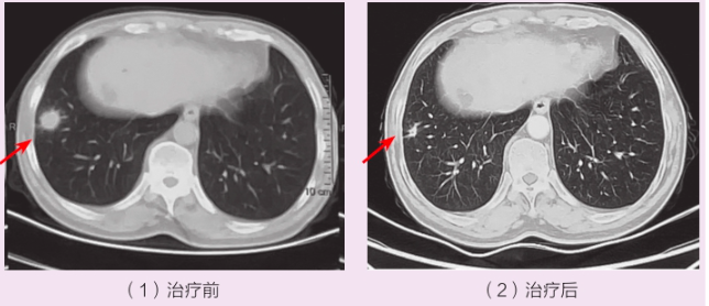 图1：右肺下叶软组织结节抗感染治疗前后变化