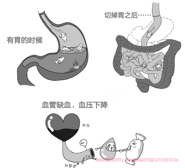 倾倒综合征