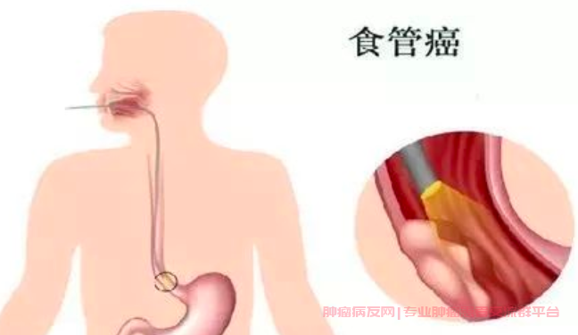 食管癌病理类型和分化程度对治疗效果的影响