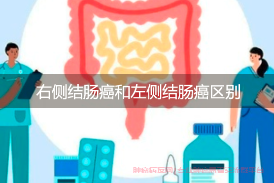 右侧结肠癌和左侧结肠癌区别