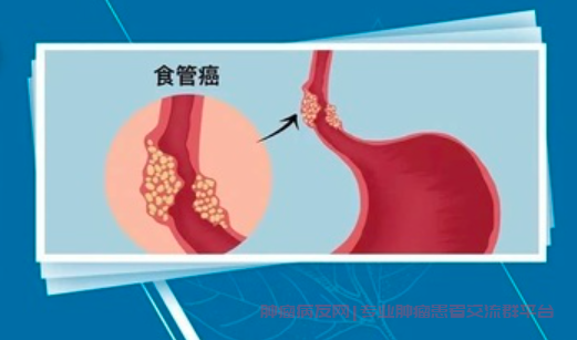 胃镜查出食管癌