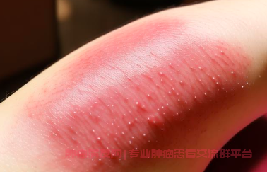 前列腺癌服用比卡鲁胺皮肤出疹子瘙痒怎么治疗？