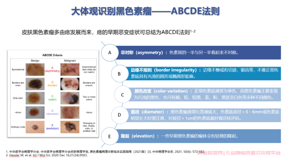 黑色瘤恶变abcde法则