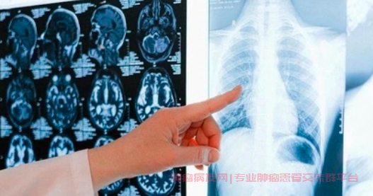 肺腺癌术后恢复期：出现白色泡沫痰，是否需要担心术后感染？