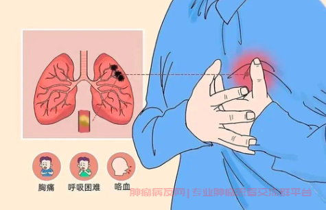 肺腺癌晚期患者在化疗期间复查CT显示肺动脉有血栓