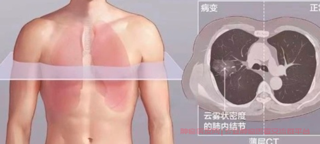 发现肺部混杂磨玻璃结节8.8mm继续随访还是直接手术？_肺磨玻璃结节群聊问答