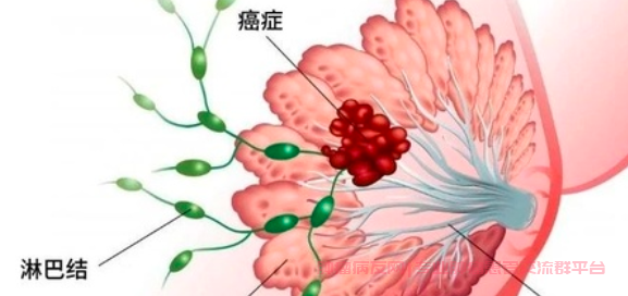 抗击乳腺癌战友群解答:乳腺癌淋巴转移并伴有皮肤及后背溃烂怎么治疗