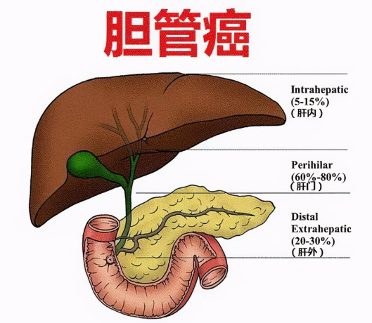 什么是胆道肿瘤，肿瘤靶向治疗的特征与优势