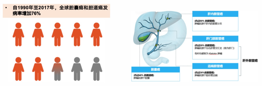 应对胆道癌：多学科综合治疗的必要性