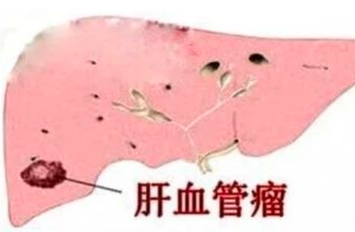 加入肝部血管瘤交流群，获取最新资讯！
