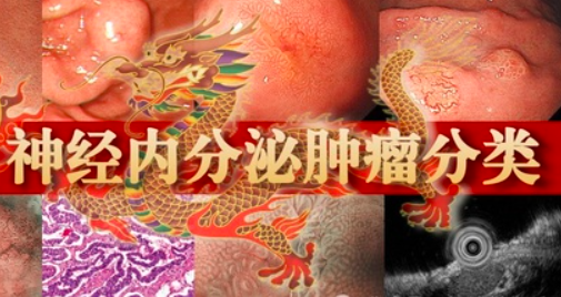 神经内分泌瘤患者群:全方位解析及支持 神经内分泌瘤患者群:全方位解析及支持