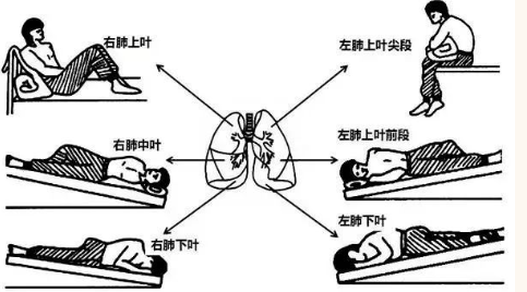 肺癌术后康复必备：科学护理与训练